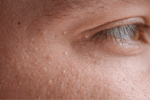 What Causes Milia — and Practical Ways to Treat it, without Damaging Your Skin - Syll Botanics